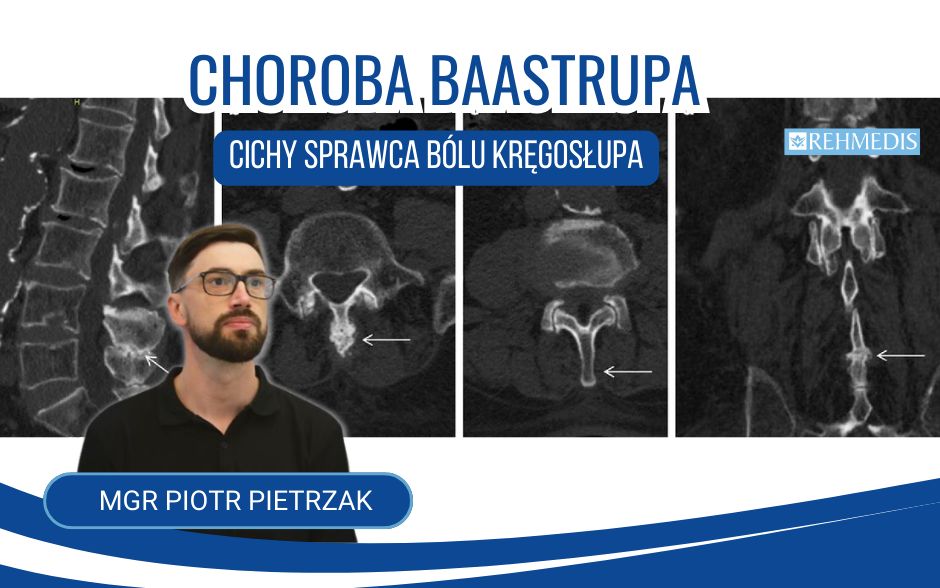 choroba-baastrupa-fizjhoterapia
