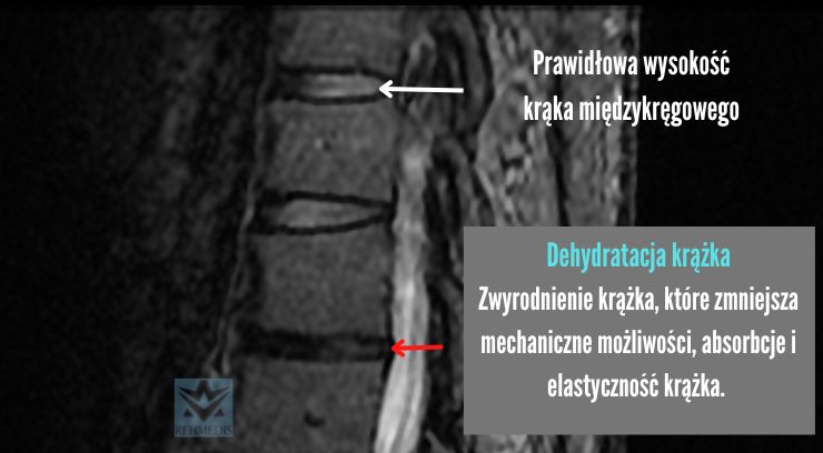 dehydratacja krążka międzykręgowego kręgoslupa