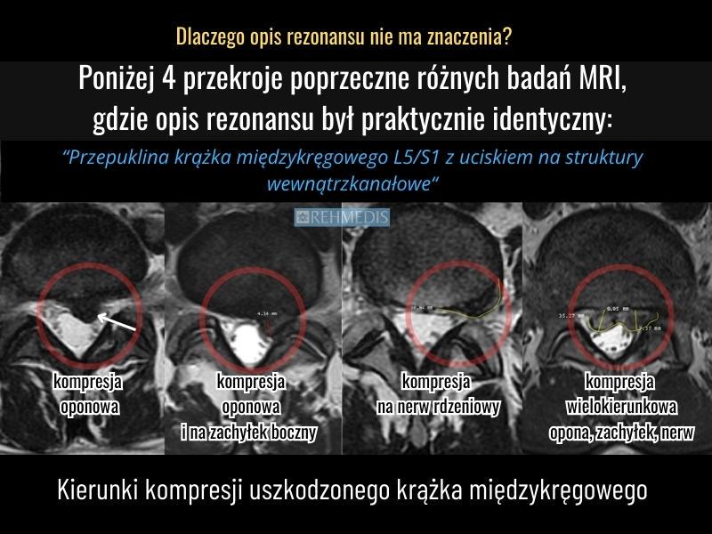 rezonans magnetyczny kręgosłupa przepuklina